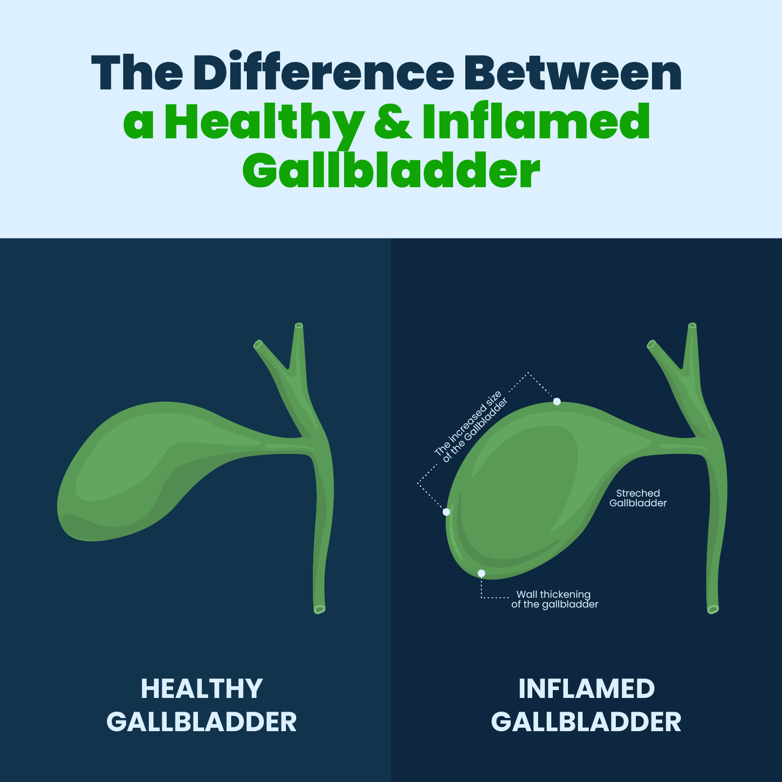 The Difference Between a Healthy and Inflamed Gallbladder